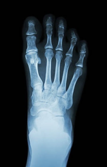 An x ray of an adult right foot showing fully formed bone structure