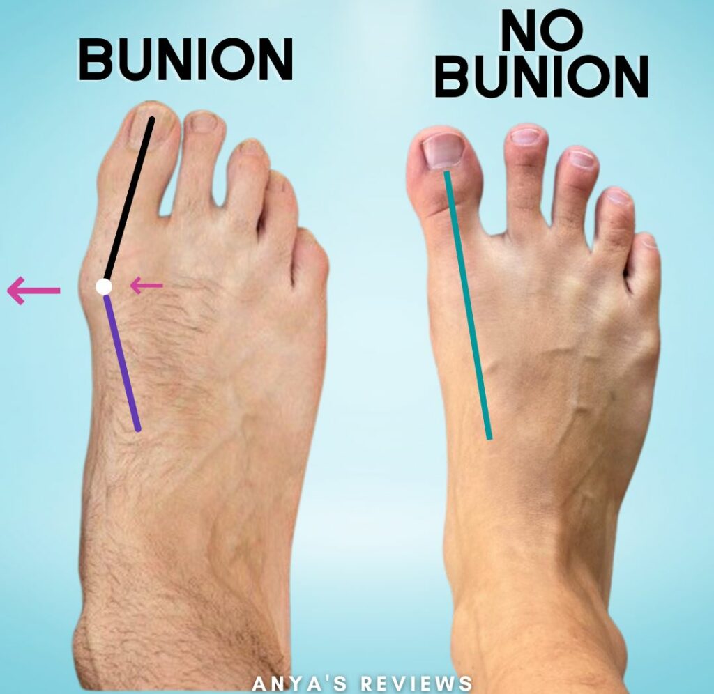 image of two feet showing What is a bunion - one has the mtp joint migrating outward, the other is a straight line from the 1st metatarsal through the big toe