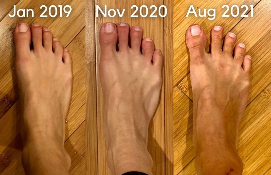 3 photo collage of the same woman's foot over the span of 2 years. In the first photo, her foot looks weak in the first photo, but clearly stronger in the next 2.