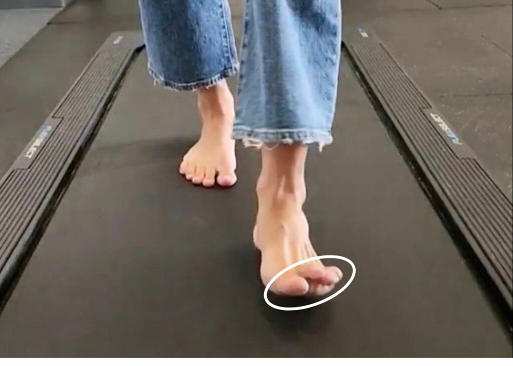 A close up of a person's feet standing on a treadmill with the left foot in swing phase - the toes are lifted dramatically up, more than they should.